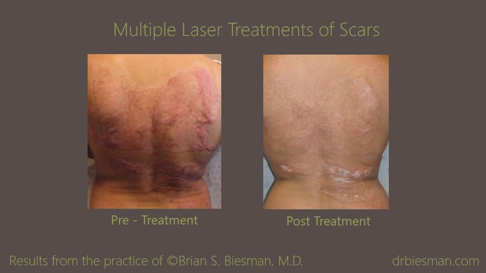 Treatment of Scarring Before and After Photo Nashville, TN