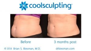 coolsculpting nashville tn