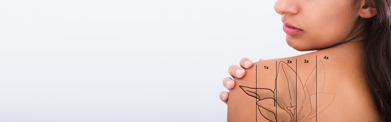 tattoo removal