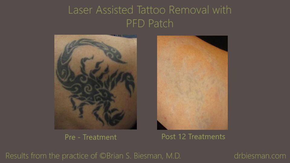 Laser Tattoo Removal Before and After Photo