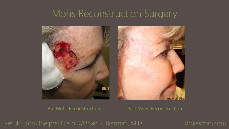 Skin Cancer of the Eyelids and Face Before and After Photo