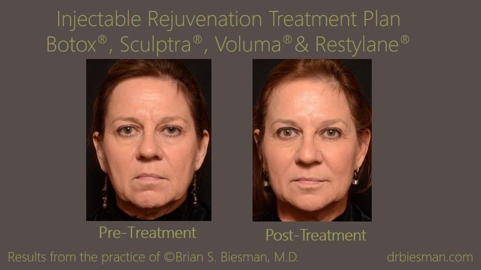 Injectable Fillers Before and After Nashville, TN
