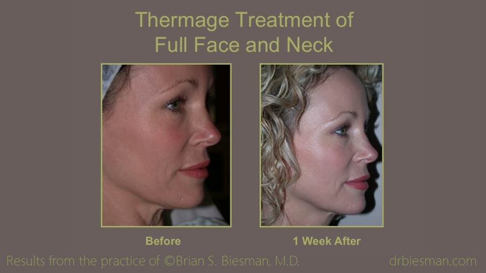 Thermage Noninvasive Skin Tightening Before and After Photo Nashville, TN