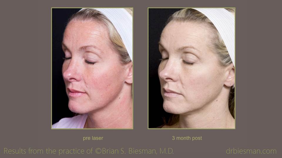 Sun Spot Treatment Before and After Photo