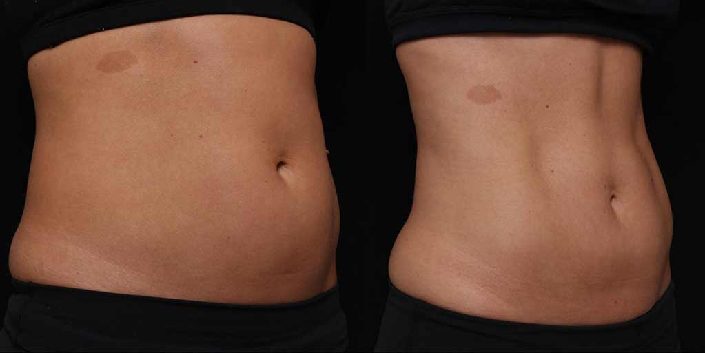 CoolSculpting before and after of abdomen for actual Nashville patient