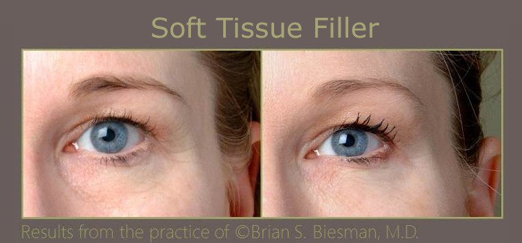 Under eye hollow treatment in Nashville