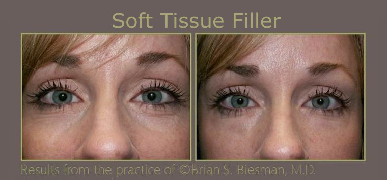 Treatment for under eye hollows in Nashville