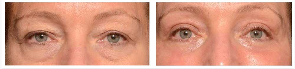 Blepharoplasty