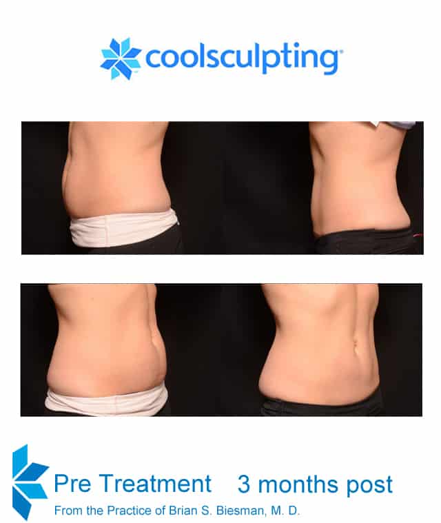 Coolsculpting treatment