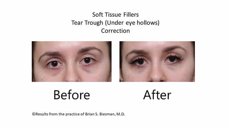 Before and after under eye filler