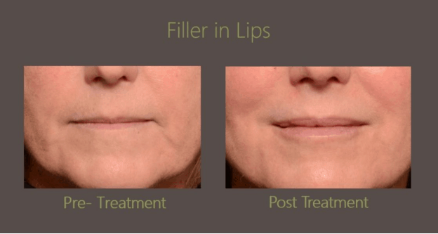 Lip Filler Before and After