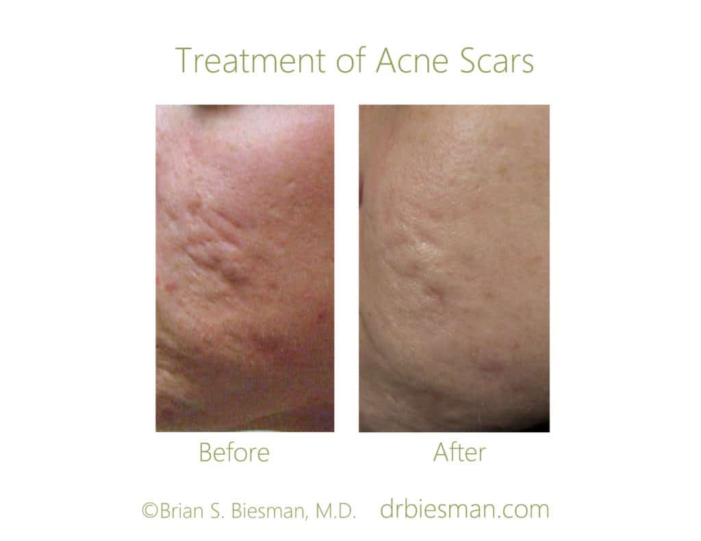 Before and After Acne Scar treatment A