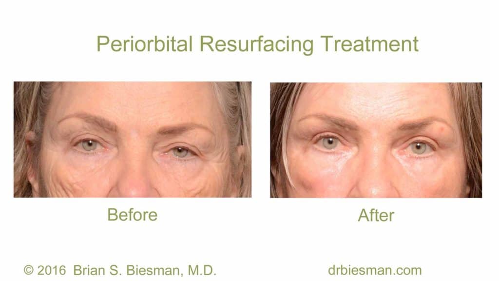 Full Face Resurfacing