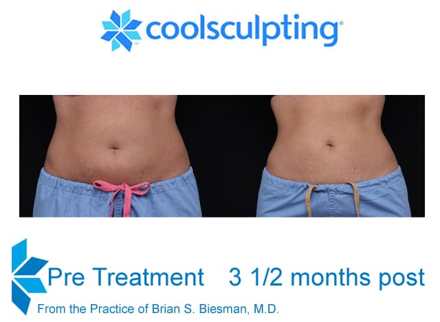 Coolsculpting B and A