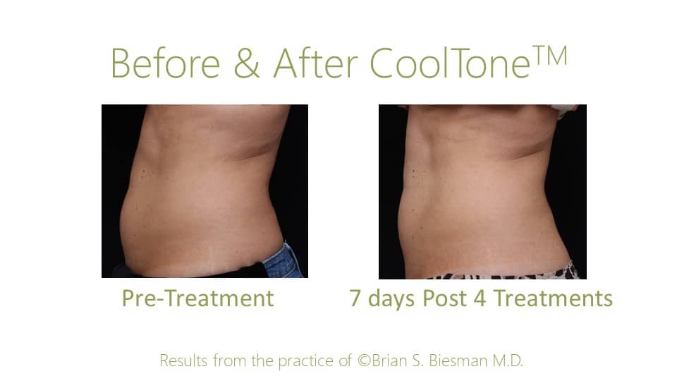 CoolTone LFT 45 pre post