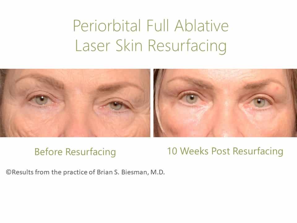 Periorbital Resurfacing