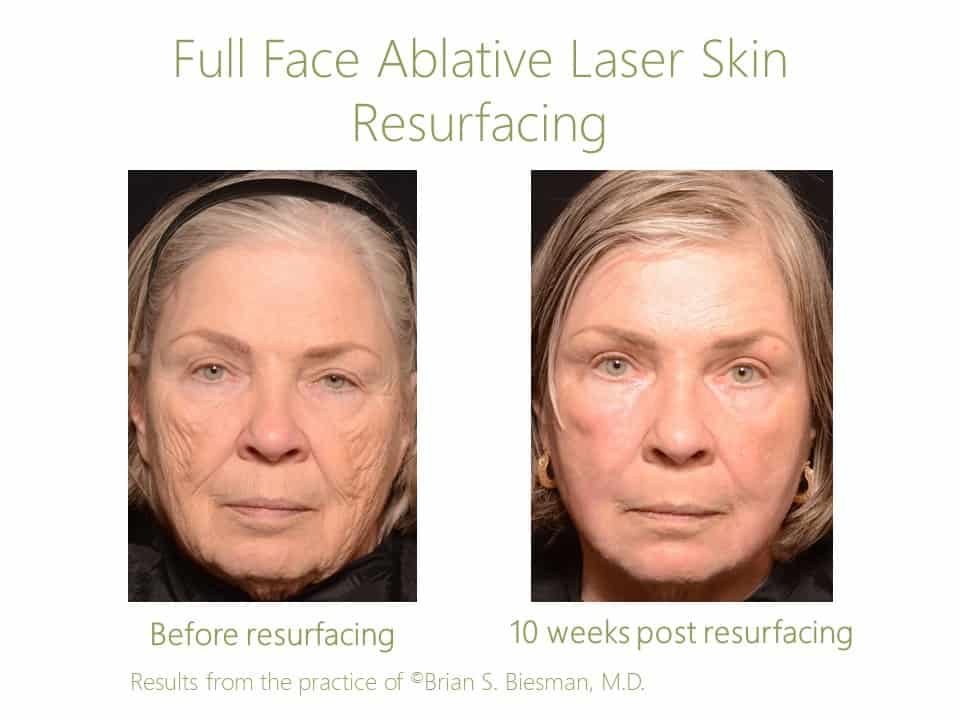 Full Face Resurfacing
