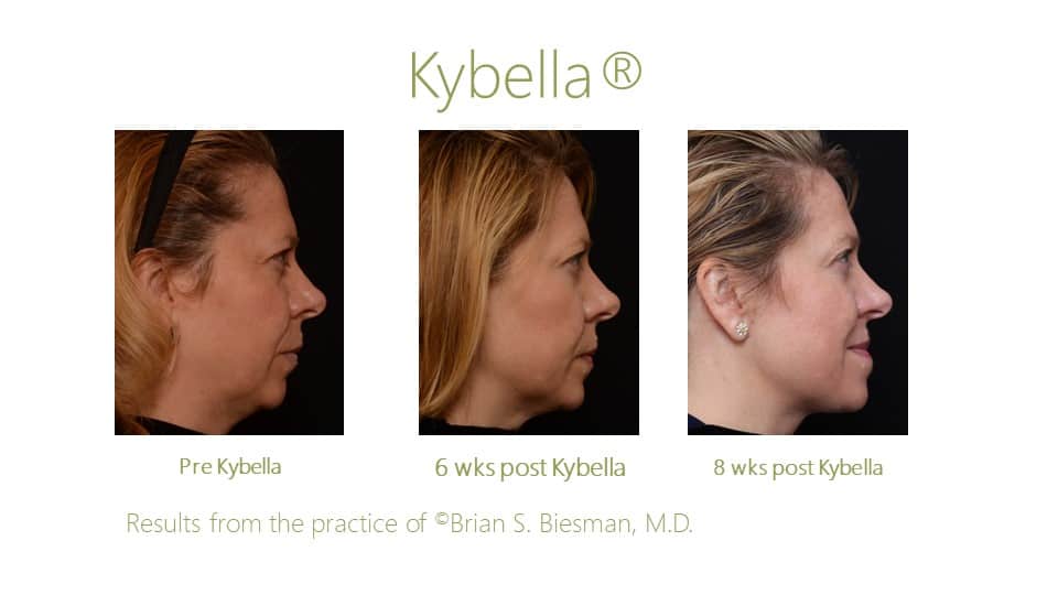 Kybella in Chin