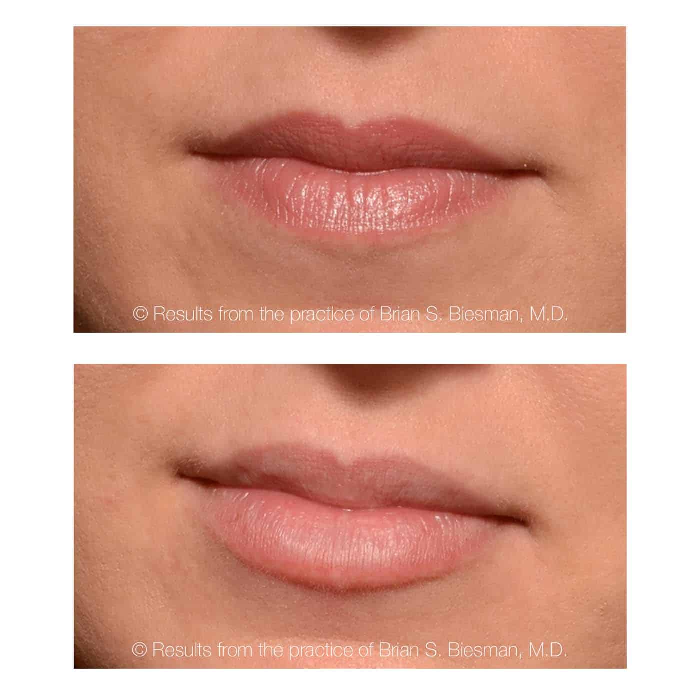 Restylane Before and After Photo Nashville, TN