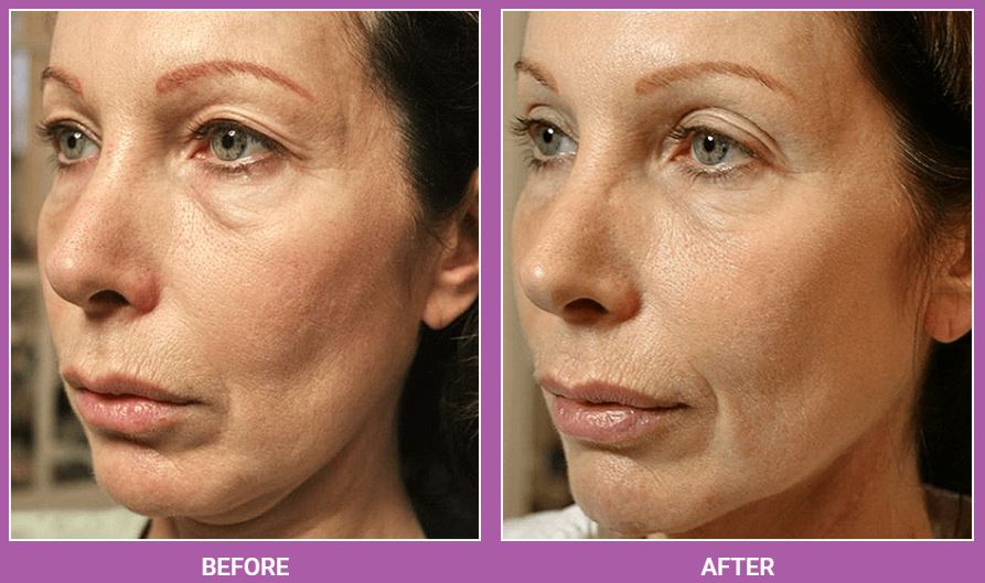 Before and After Thermage