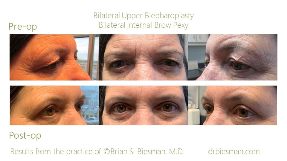 EYELID, FOREHEAD AND EYEBROW SURGERIES before and after