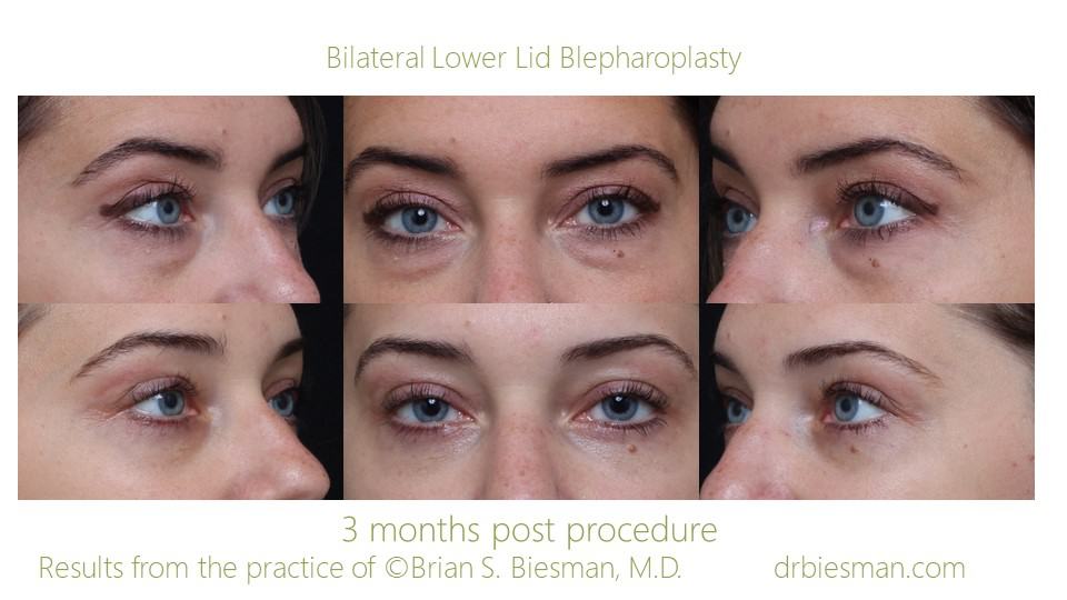 Eyelid surgery before and after