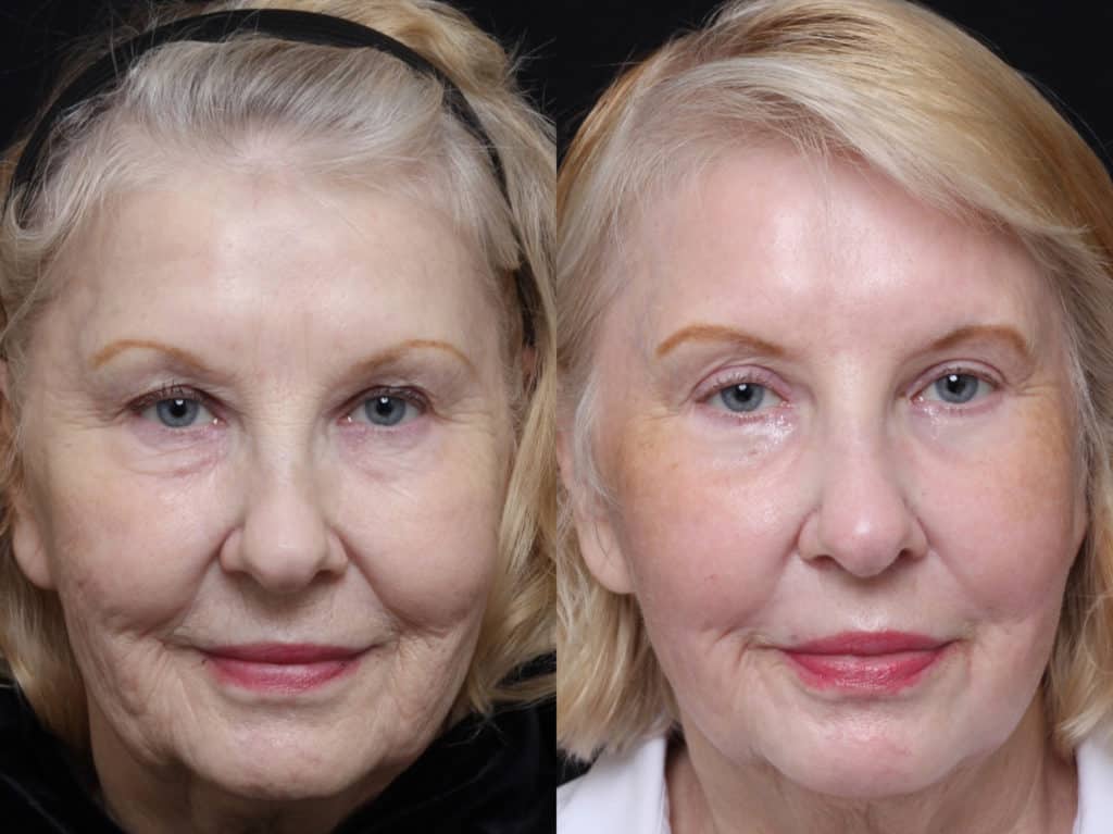 Ablative Laser Skin Resurfacing