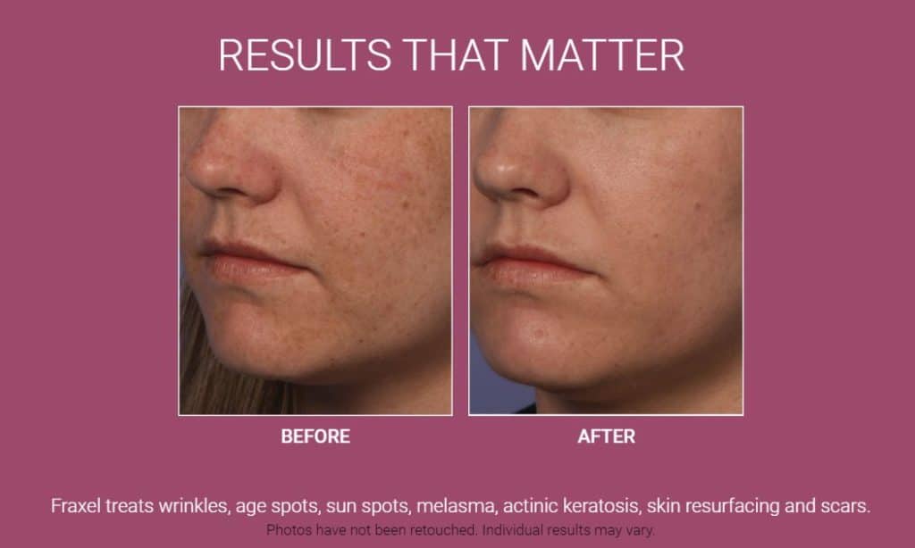 Fraxel before and after