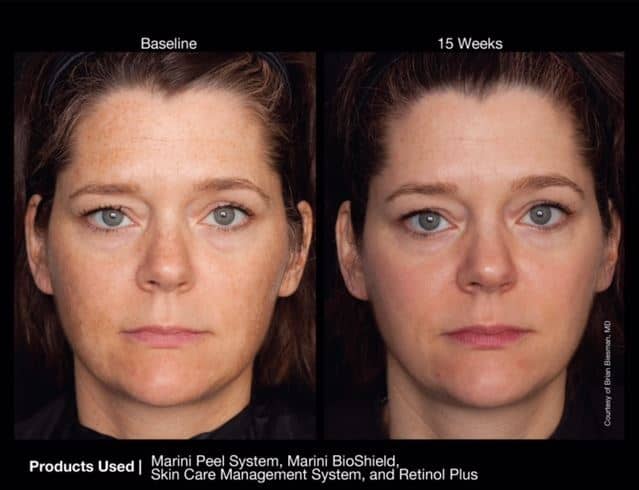 Chemical Peel Before and After