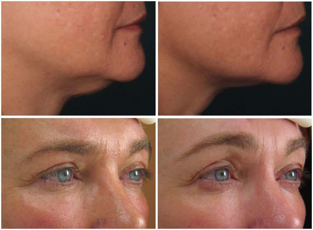 Ultherapy Before and After