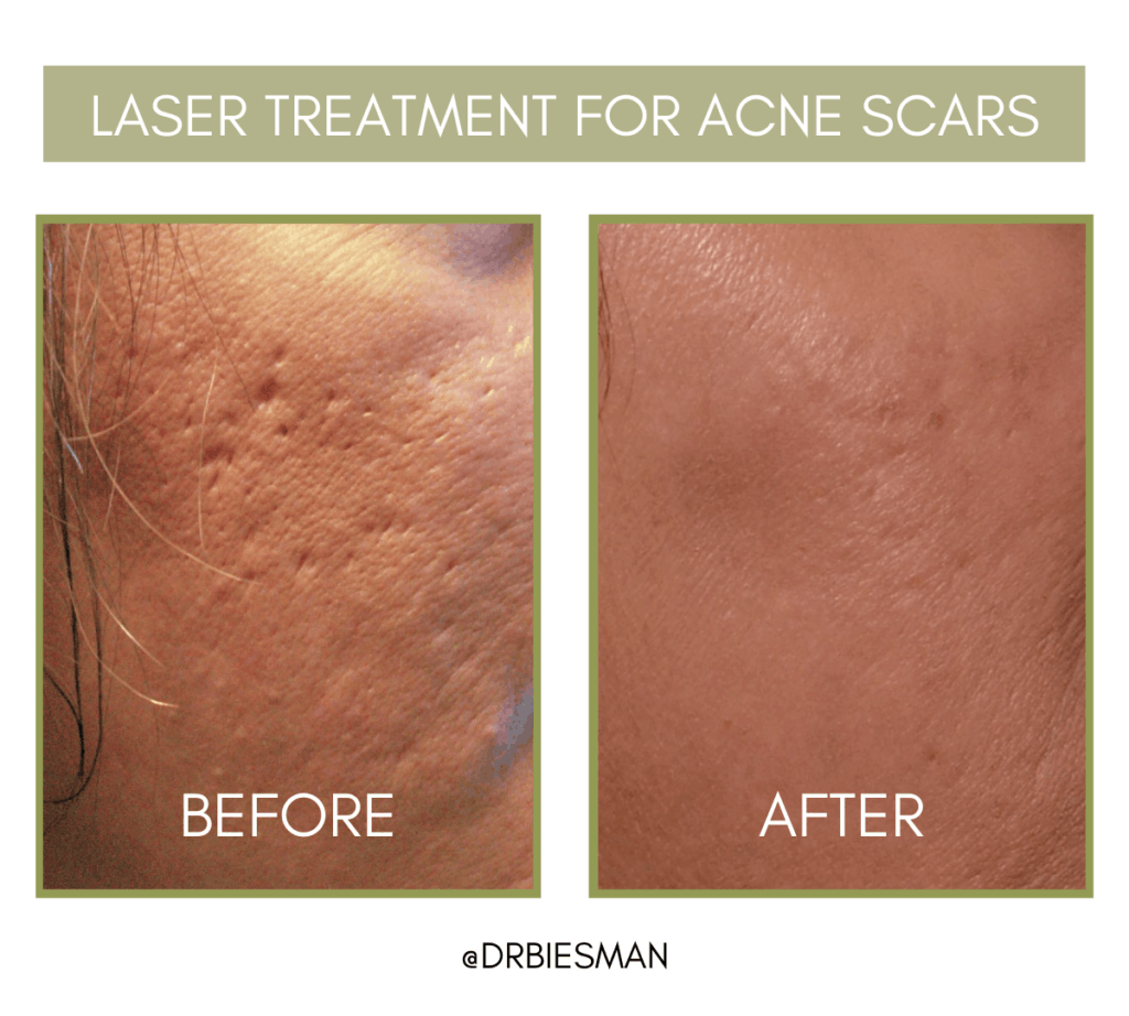 Acne Scar Treatment Nashville