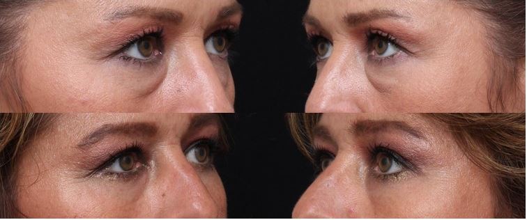 Tear Trough Filler vs Blepharoplasty