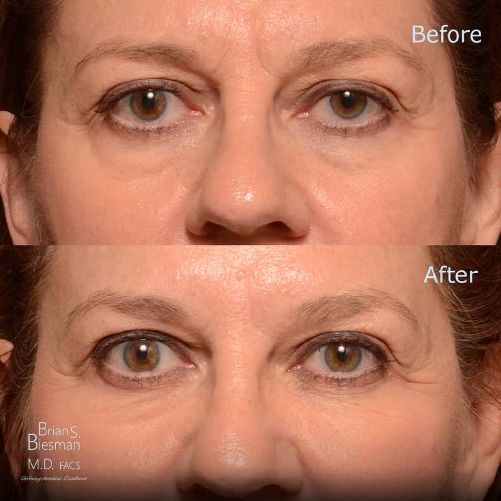 Tear Trough Injections