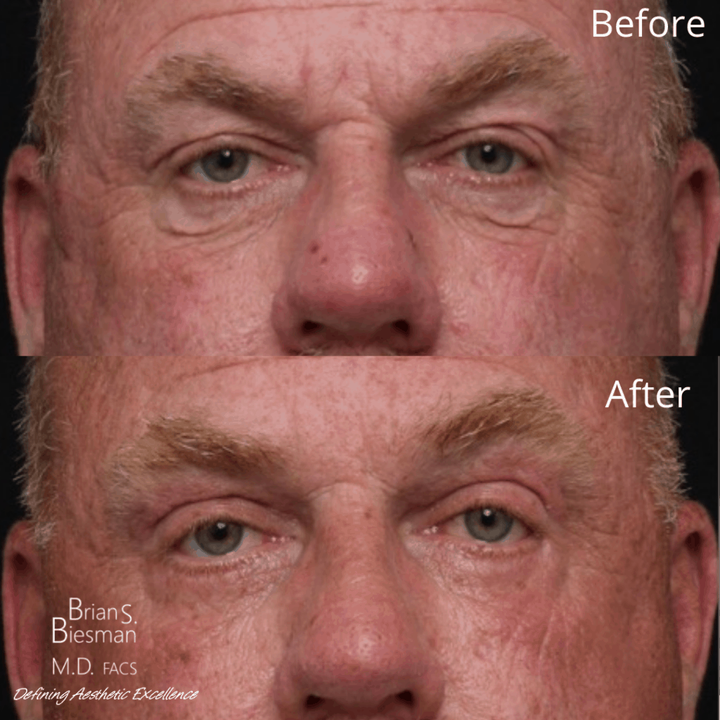 blepharoplasty before and after