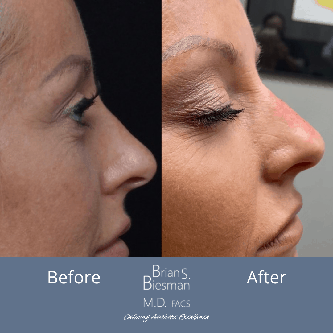 Non-Surgical Rhinoplasty Nashville