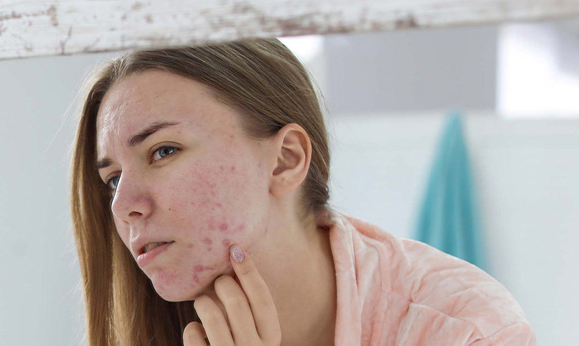 Acne Treatment Nashville