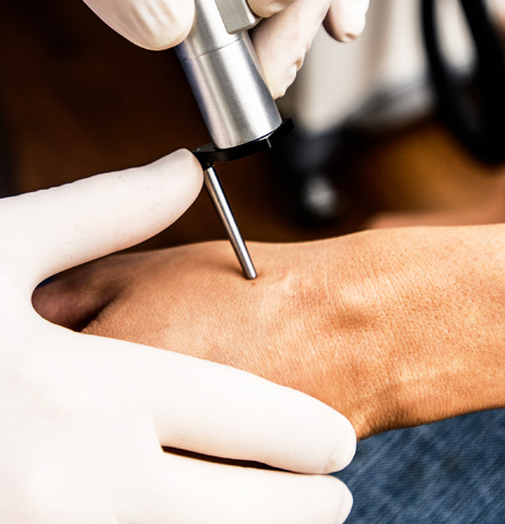 Scar Treatment Nashville
