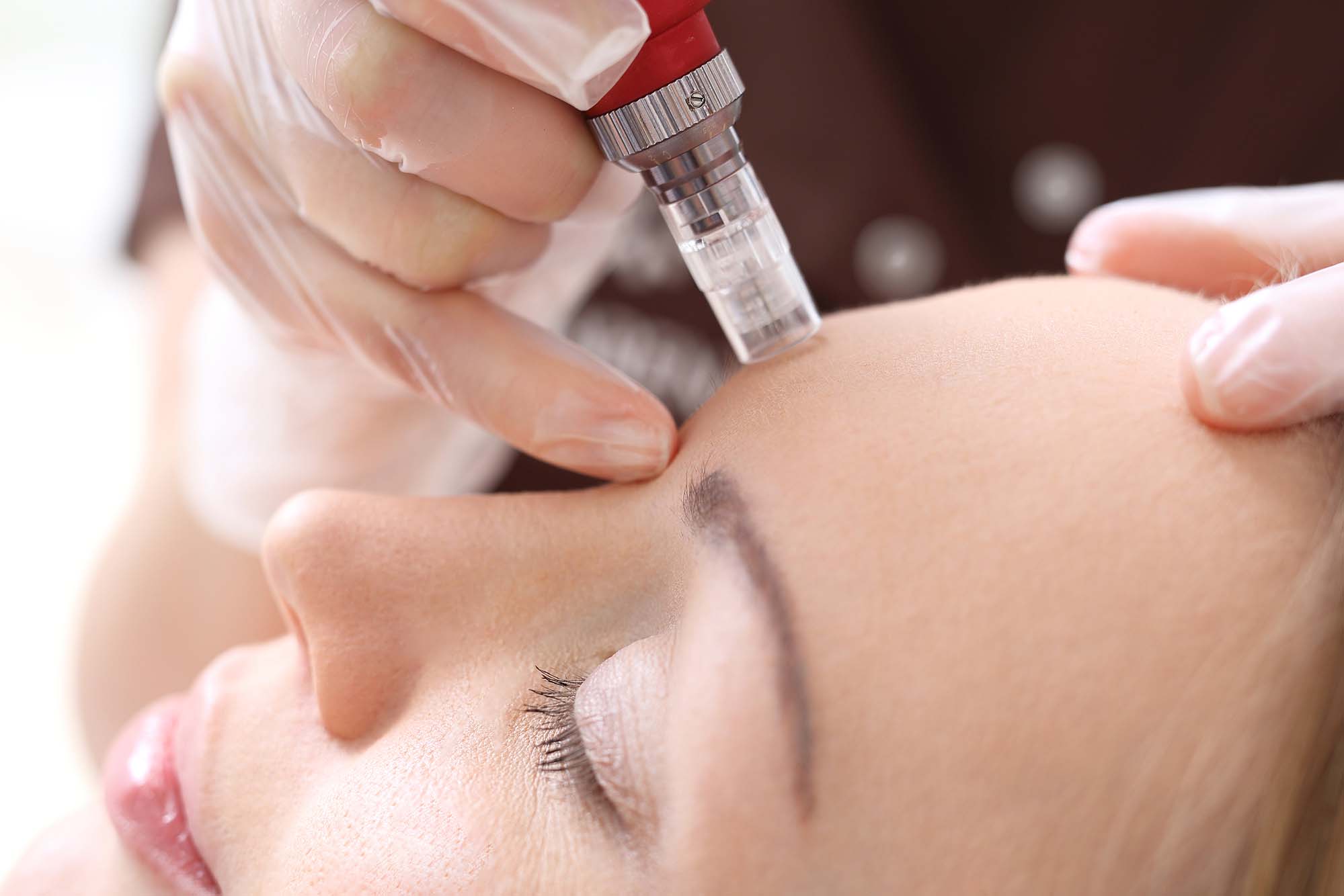 Microneedling Nashville