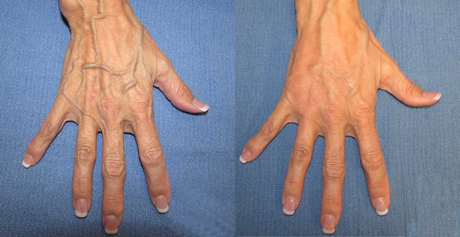 Radiesse Before and after Nashville