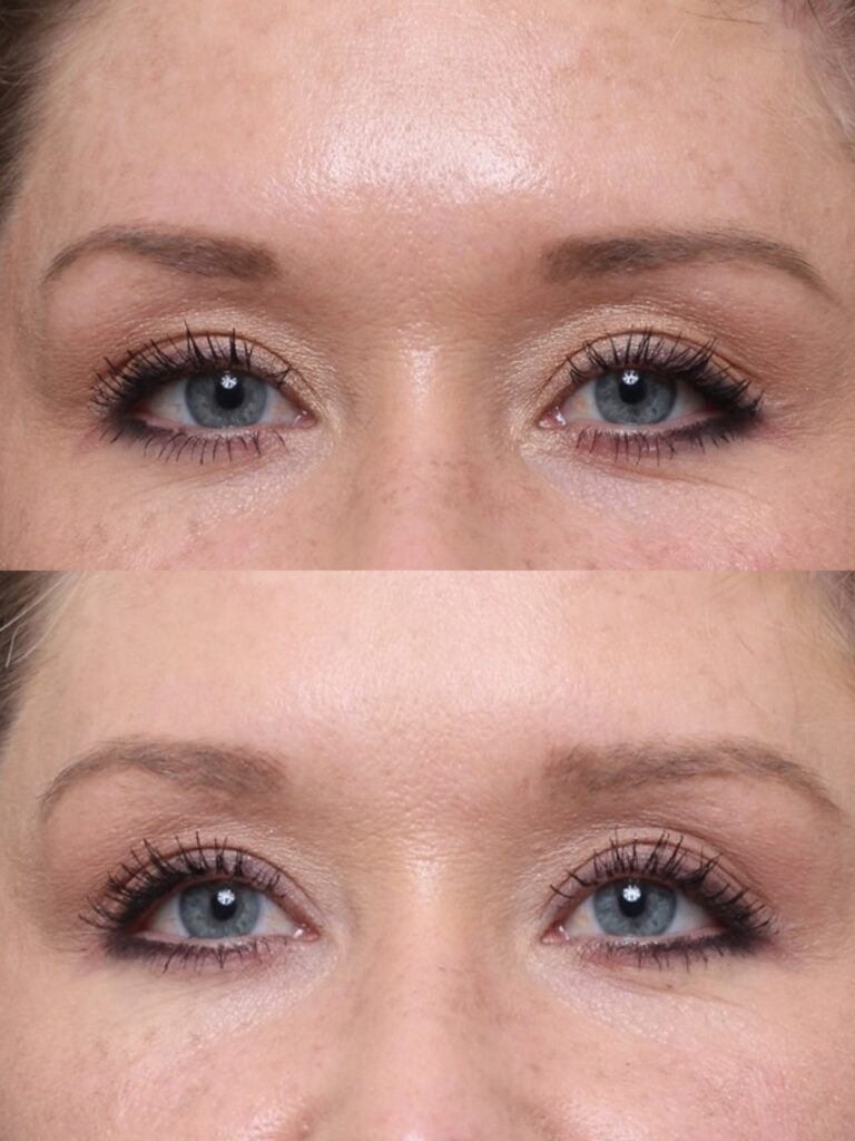 Botox Treatment of Forehead
