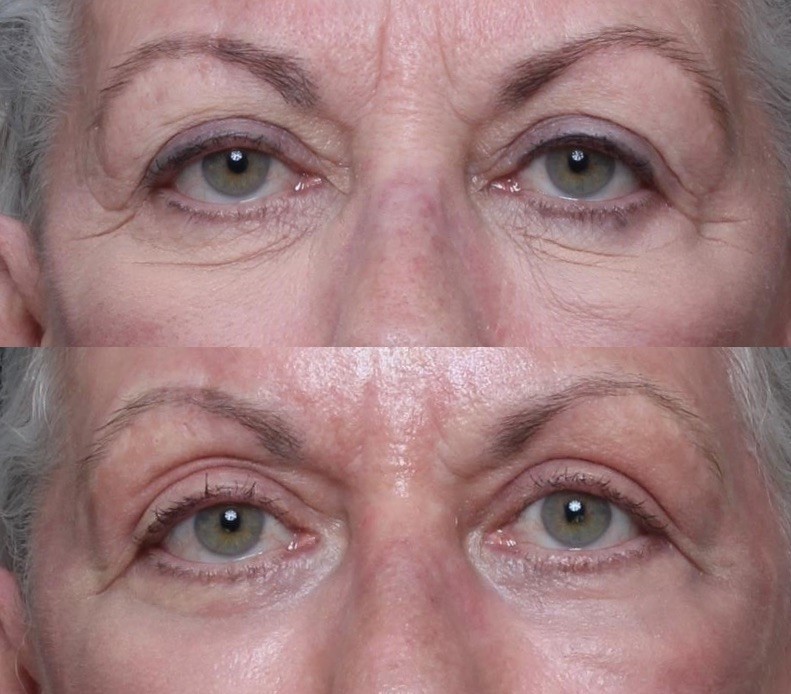 3 months post Full Ablative laser skin resurfacing treatment