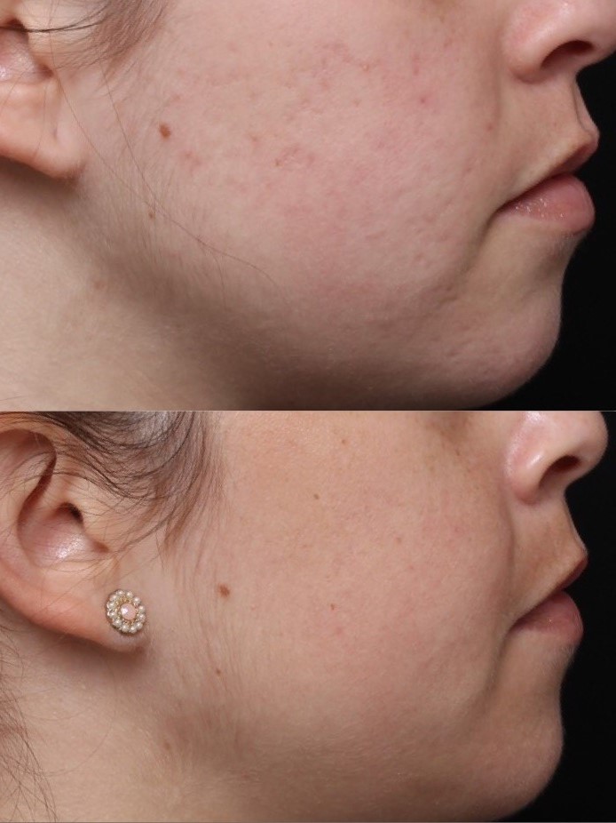 Fraxel 1550 and PRP Result