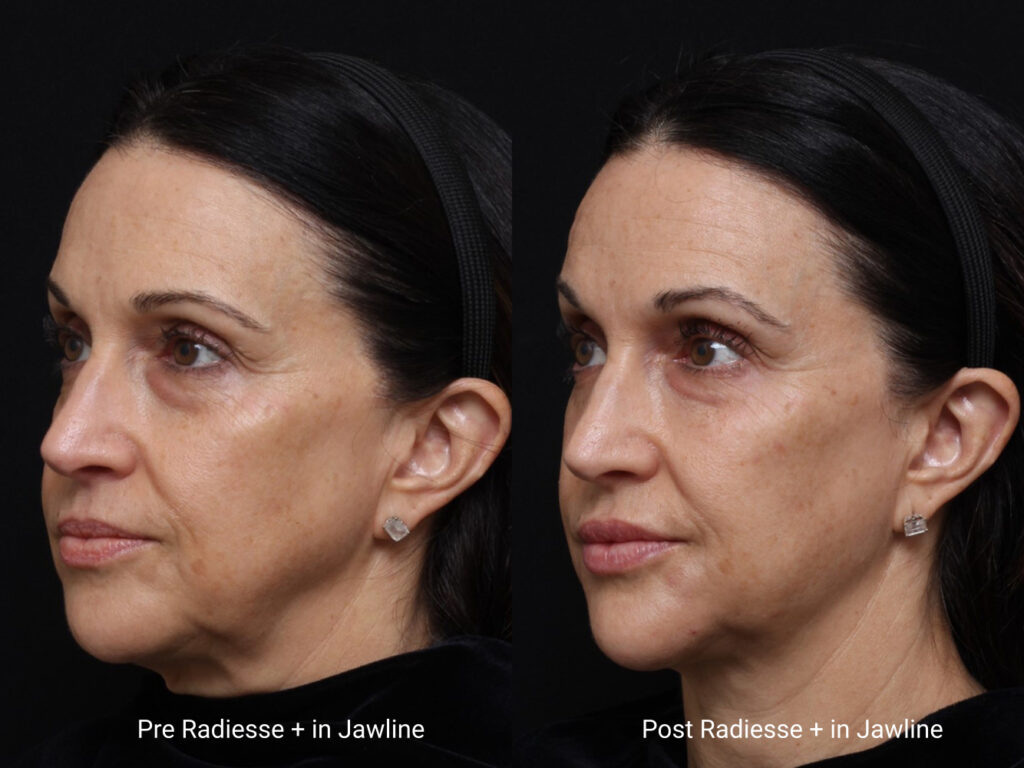 Radiesse + in Jawline