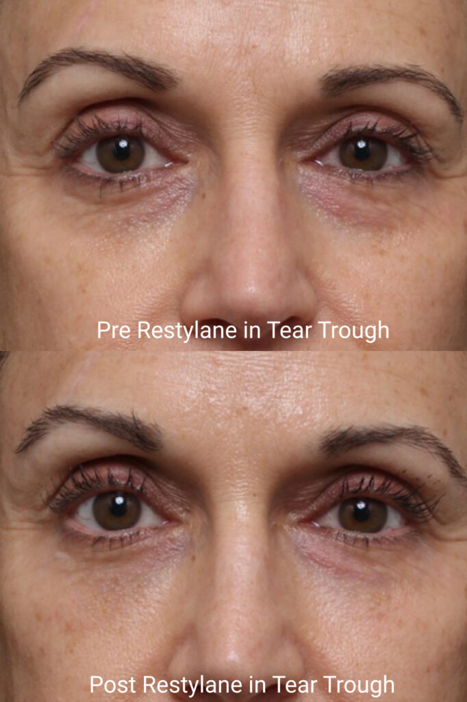 Tear Trough Filler - Results & ©Brian S. Biesman, M.D.