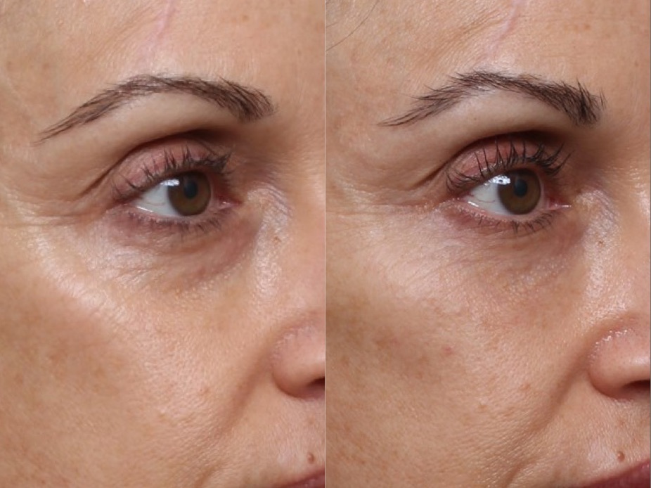 Tear Trough Filler