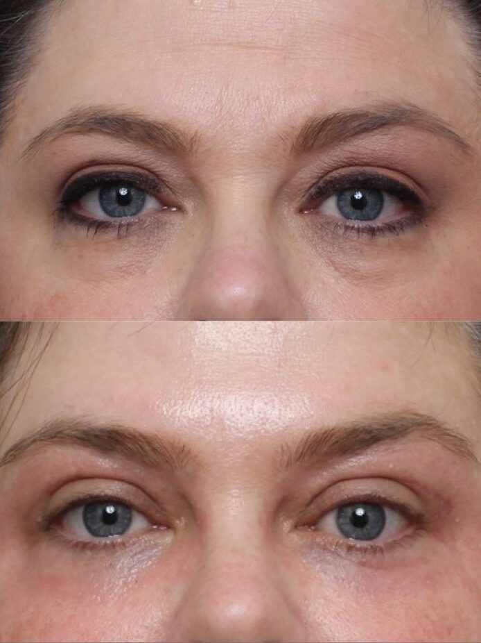 2 months post Bilateral Upper & Lower Lid Blepharoplasty. Periorbital Laser Resurfacing