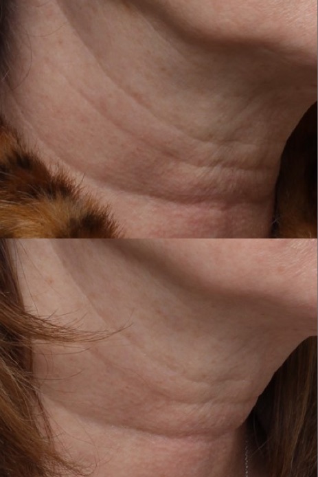 Dilute Radiesse NECK #1 tx - Results & ©Brian S. Biesman, M.D.
