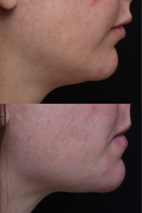 Jawline Botox Treatment