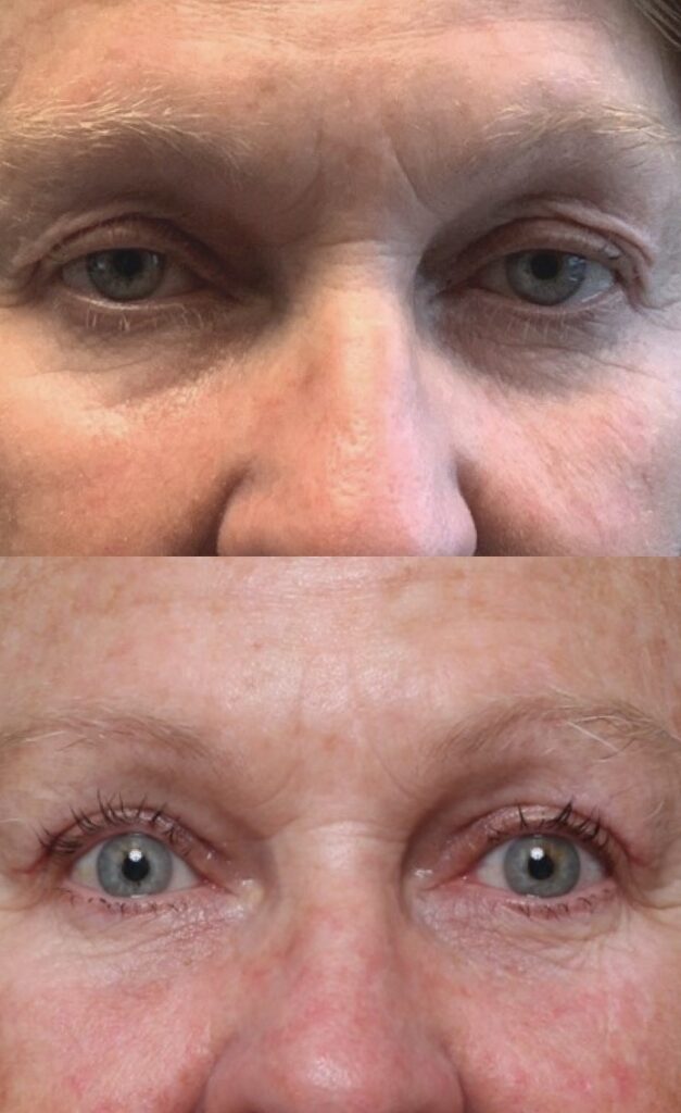 Bilateral Upper Lid Blepharoplasty & Eyelid Ptosis Repair - Results & ©Brian S. Biesman, M.D. 2