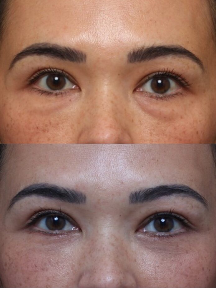 Bilateral Upper Lid Blepharoplasty 7